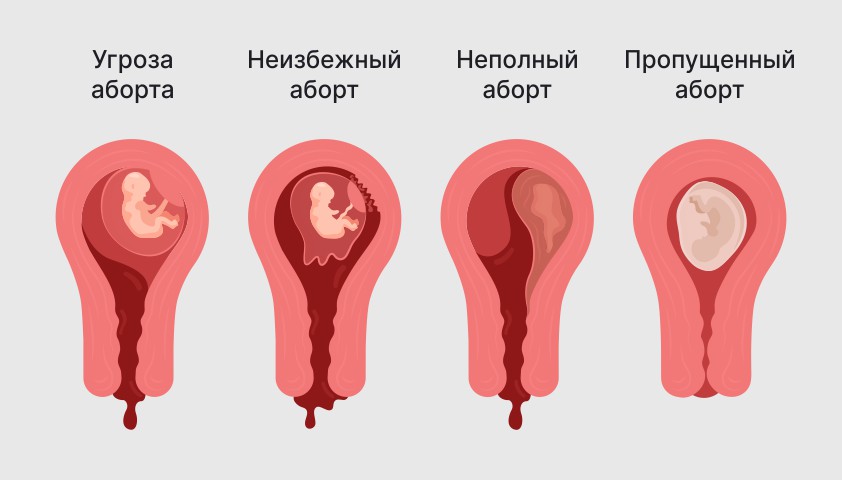 Кровотечение при беременности - в 1, 2 или 3 триместре, что делать