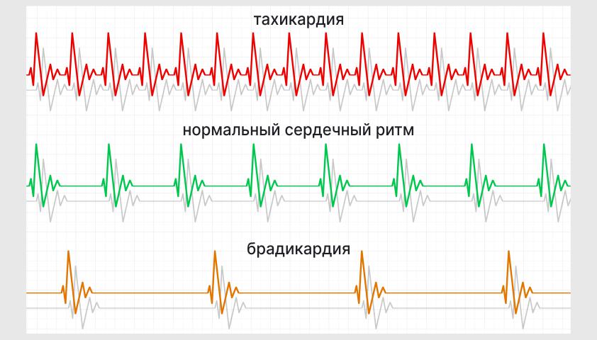 Брадикардия сердца - что это, причины, симптомы и лечение