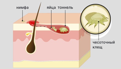 Чесоточный клещ