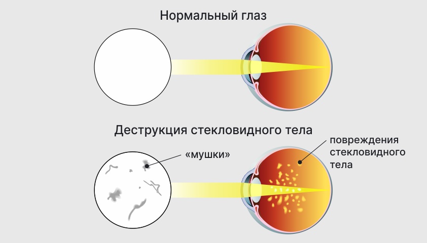 Деструкция стекловидного тела - что это, причины, симптомы