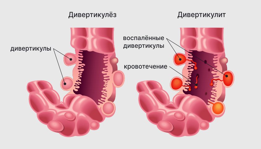 Дивертикулярная болезнь (дивертикулёз и дивертикулит кишечника) — что это, причины формирования дивертикулов, симптомы, лечение