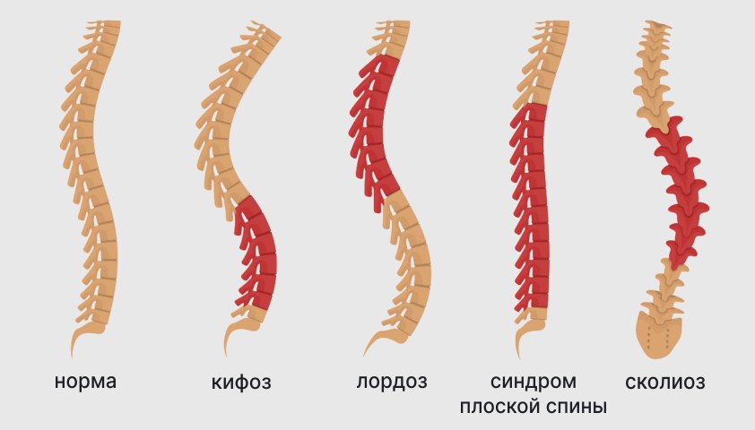 Дорсопатия