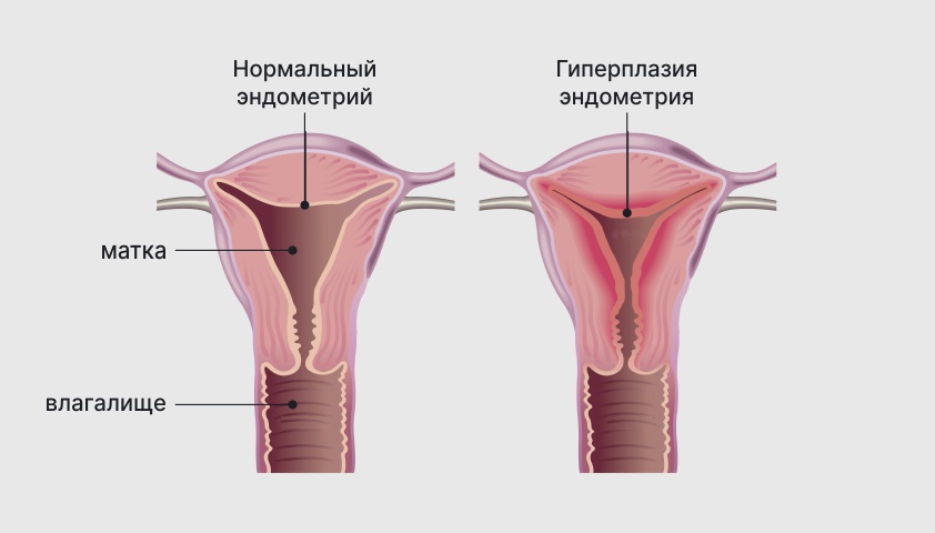 Гиперплазия эндометрия матки — что это, симптомы и лечение