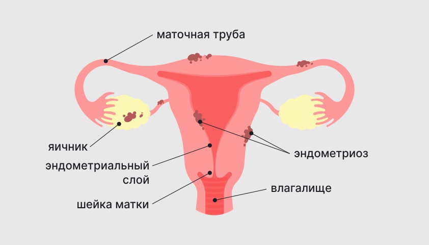 Эндометриоз - что это, причины, симптомы и лечение