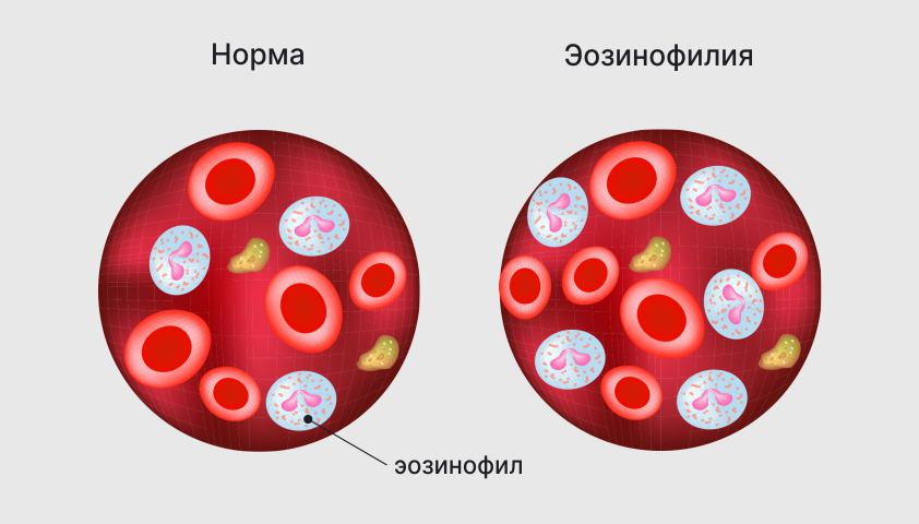 Эозинофилы увеличены в крови у взрослых