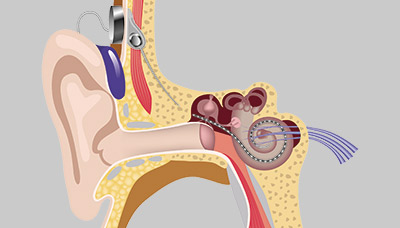 Кохлеарный имплантат