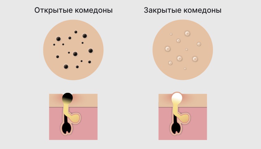 Комедоны (чёрные точки) - причины, как избавиться