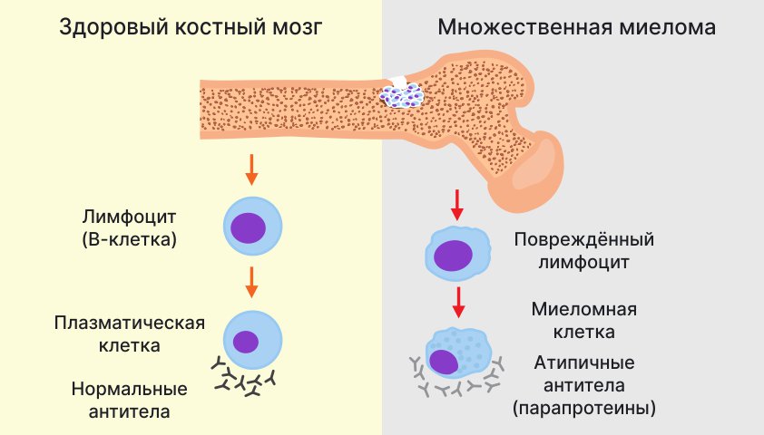 Миеломная болезнь - симптомы, профилактика и лечение