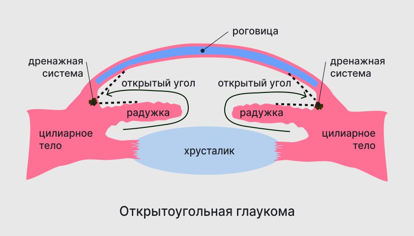 Глаукома - что это, симптомы, признаки и лечение