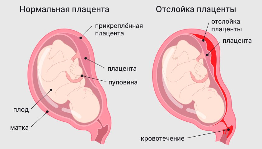 Кровотечение при беременности - в 1, 2 или 3 триместре, что делать