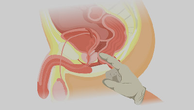 Изображение пальцевого ректального исследования простаты