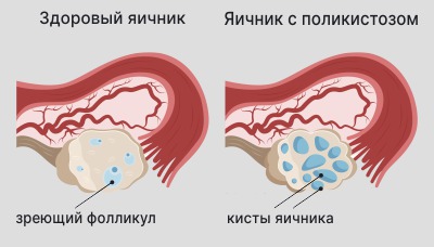 Поликистоз