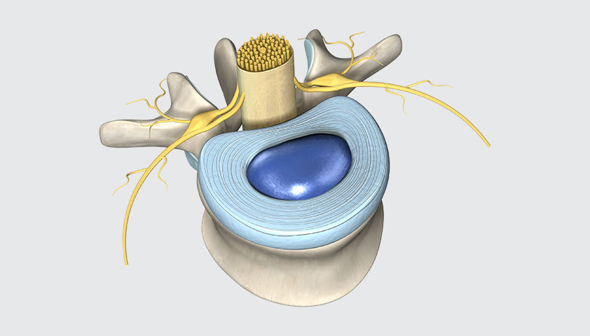Межпозвонковая грыжа — что это такое, симптомы грыжи МПД, чем опасна, лечение