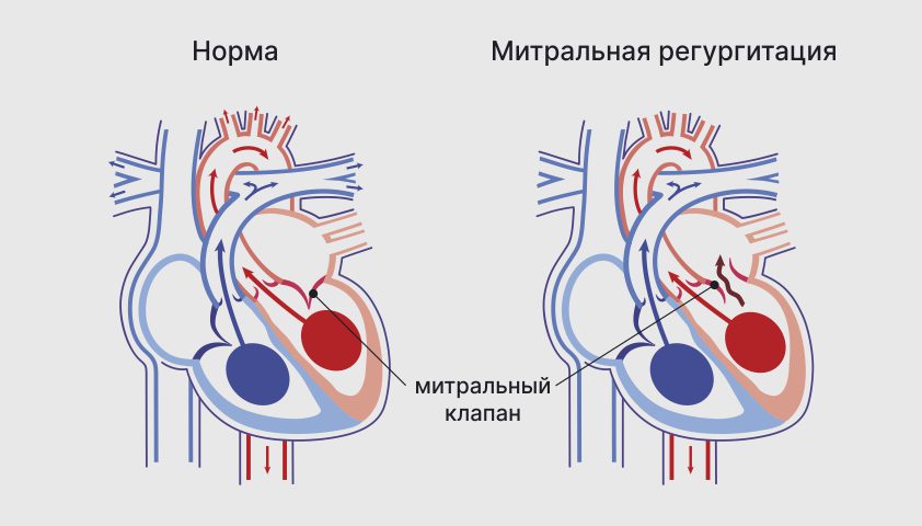 Недостаточность митрального клапана - что это, какие степени, причины