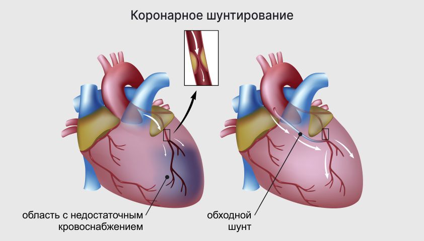 Шунтирование