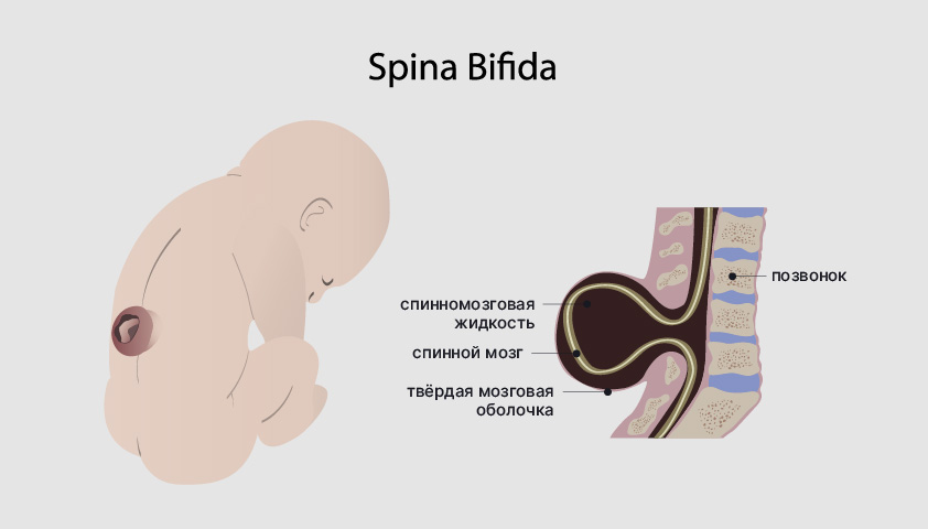 Spina