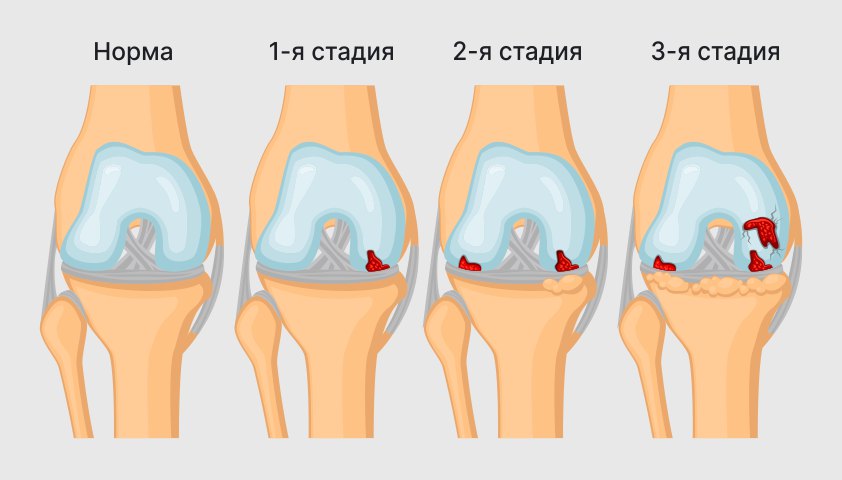 Рак кишечника — симптомы у женщин и у мужчин, виды, стадии, лечение