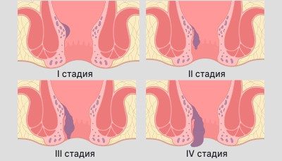 Стадии геморроя