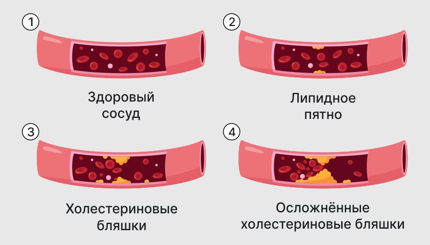 Изображение, показывающее развитие атеросклероза