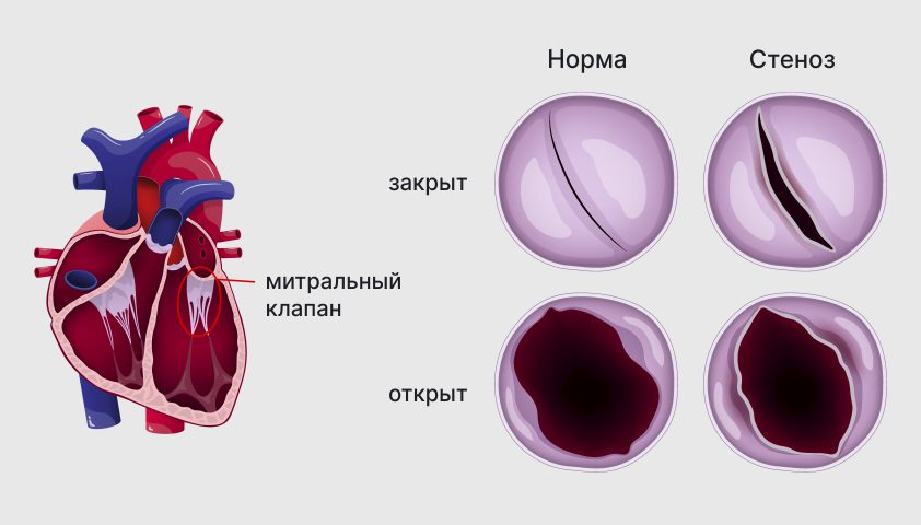 Стеноз трахеи и бронхов — симптомы, причины, виды, диагностика и лечение