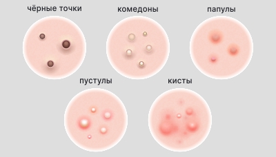 Комедоны (чёрные точки) - причины, как избавиться