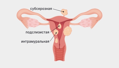 Виды-миом