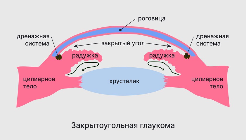 Глаукома - что это, симптомы, признаки и лечение